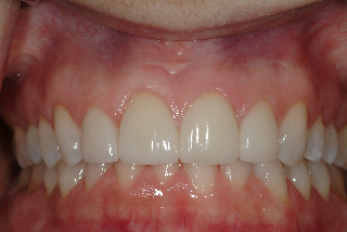 after gum recontouring and veneers