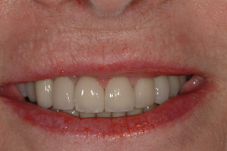 after gum treatment and new crowns