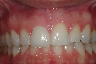 before uneven gum issue