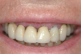 unhealthy gum tissue and poor fitting crowns